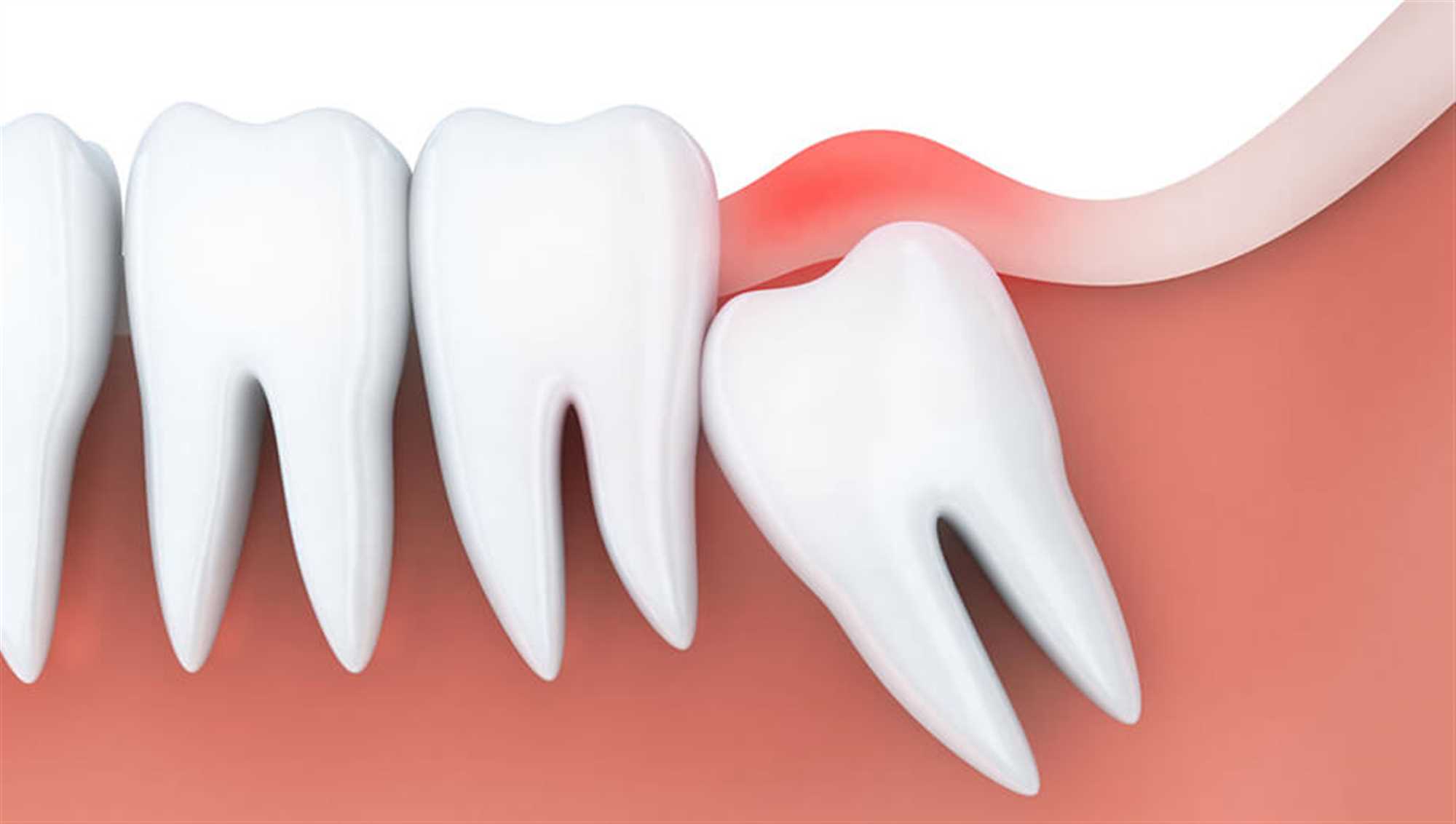 علائم عفونت بعد از کشیدن دندان عقل + راهکار های درمانی