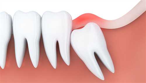 دندان پزشک-دندان عقل-عفونت دندان عقل بعد از کشیدن-عفونت دندان عقل-عفونت دندان-عفونت در دهان -بوی بد در دهان-درد زیاد فک بعد از کشیدن دندادن